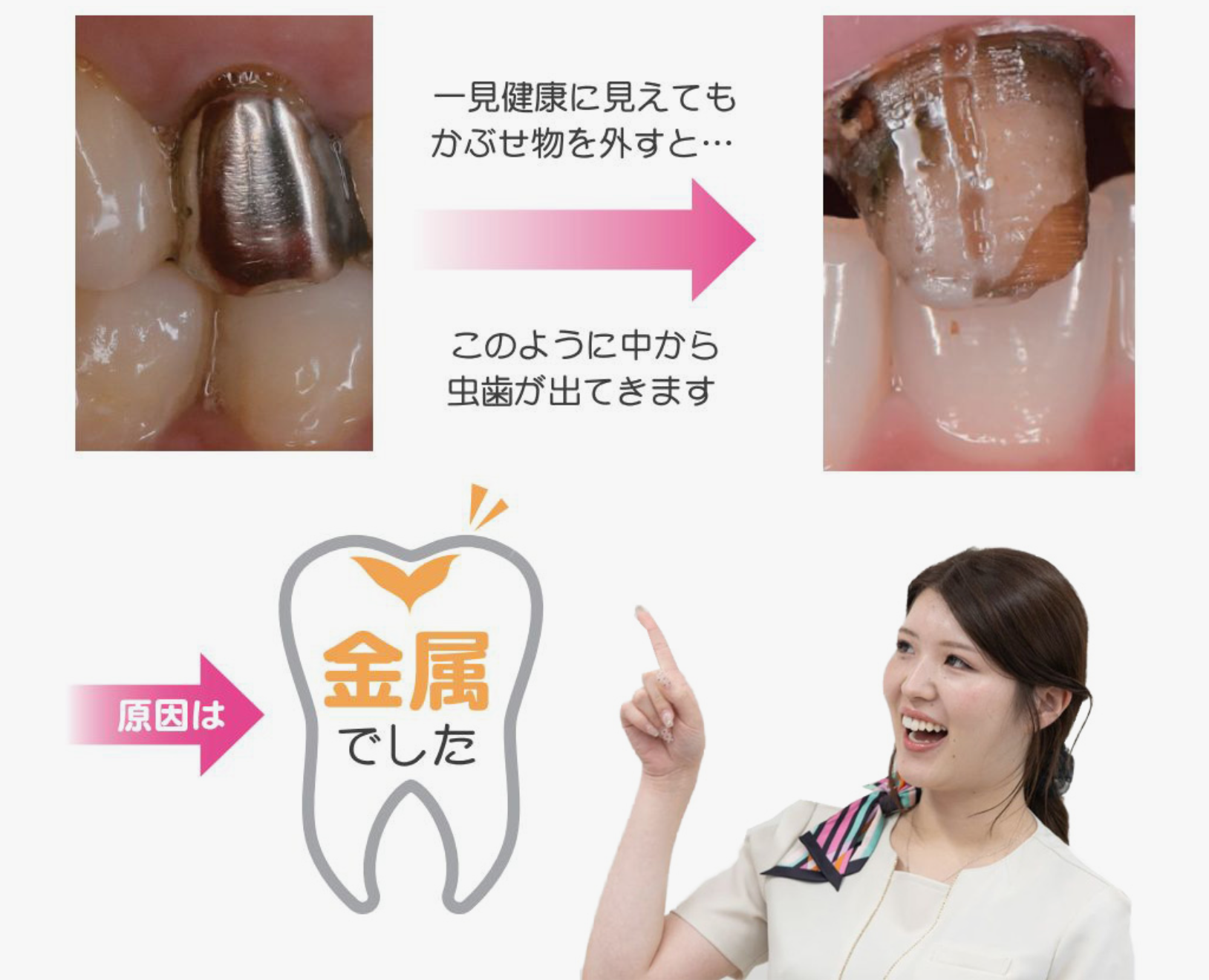 一見健康に見えてもかぶせ物を外すと…このように中から虫歯がでてきます。原因は金属でした