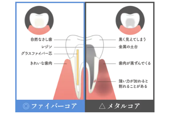 ファイバーコア：自然な差し歯、レジン、グラスファイバー芯、きれいな歯肉 メタルコア：黒く見えてしまう、金属の土台、歯肉が黒ずんでくる、強い力が加わると割れることがある